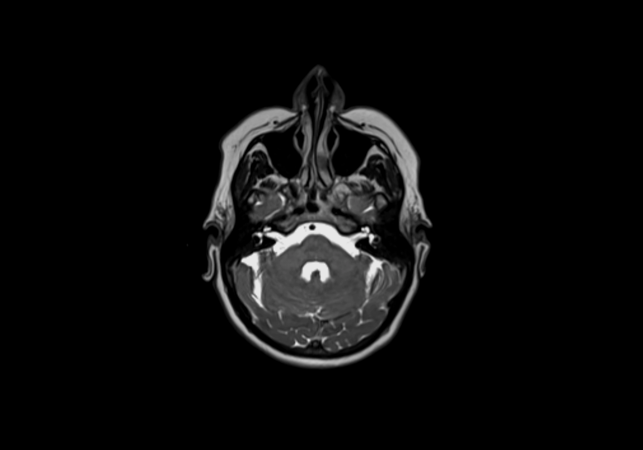 Neck axial  lymph node cross sectional MRI anatomy 3T MRI  image-img-00001-00015.webp